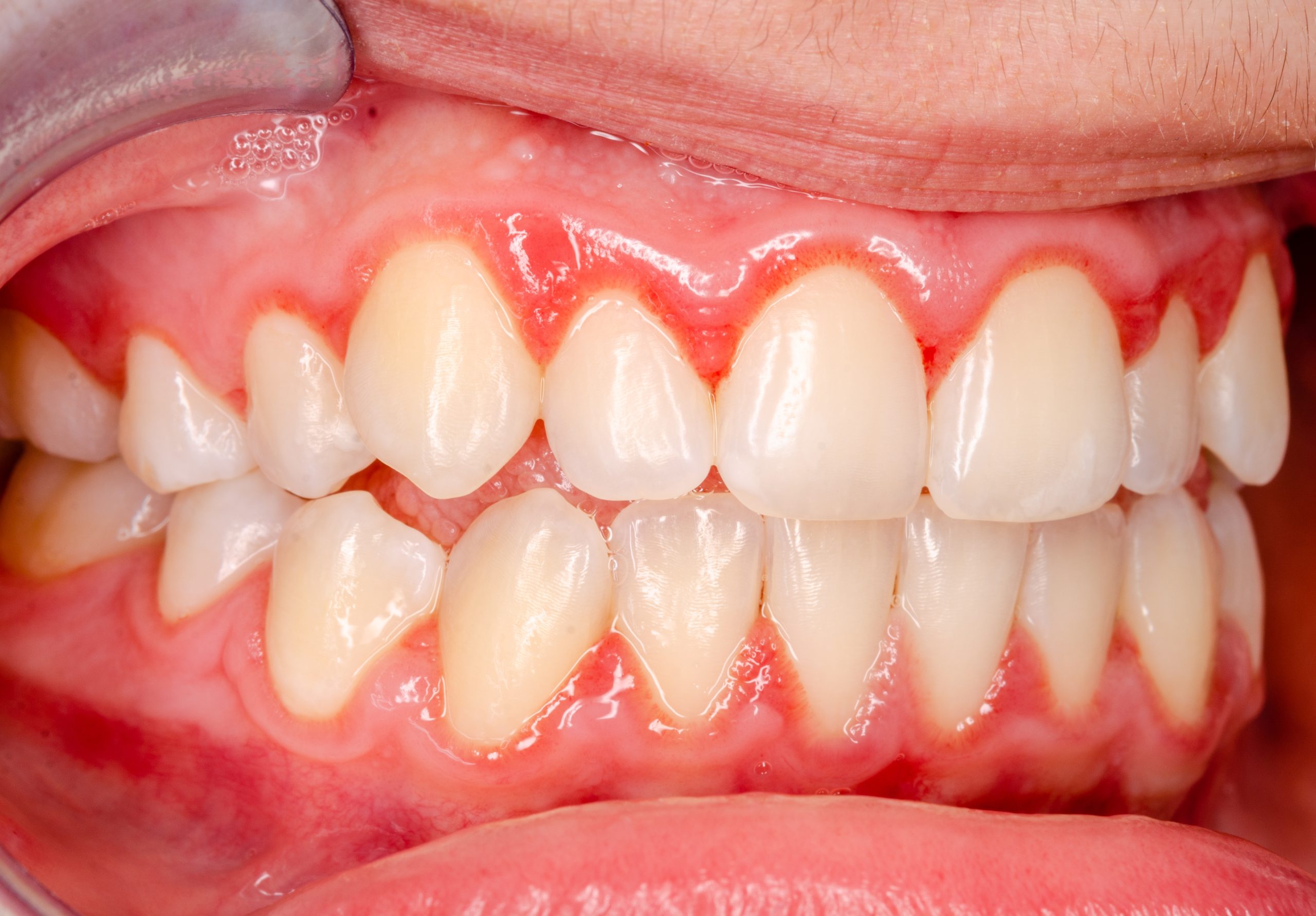 Gingivitis, Kiefer Family Dental