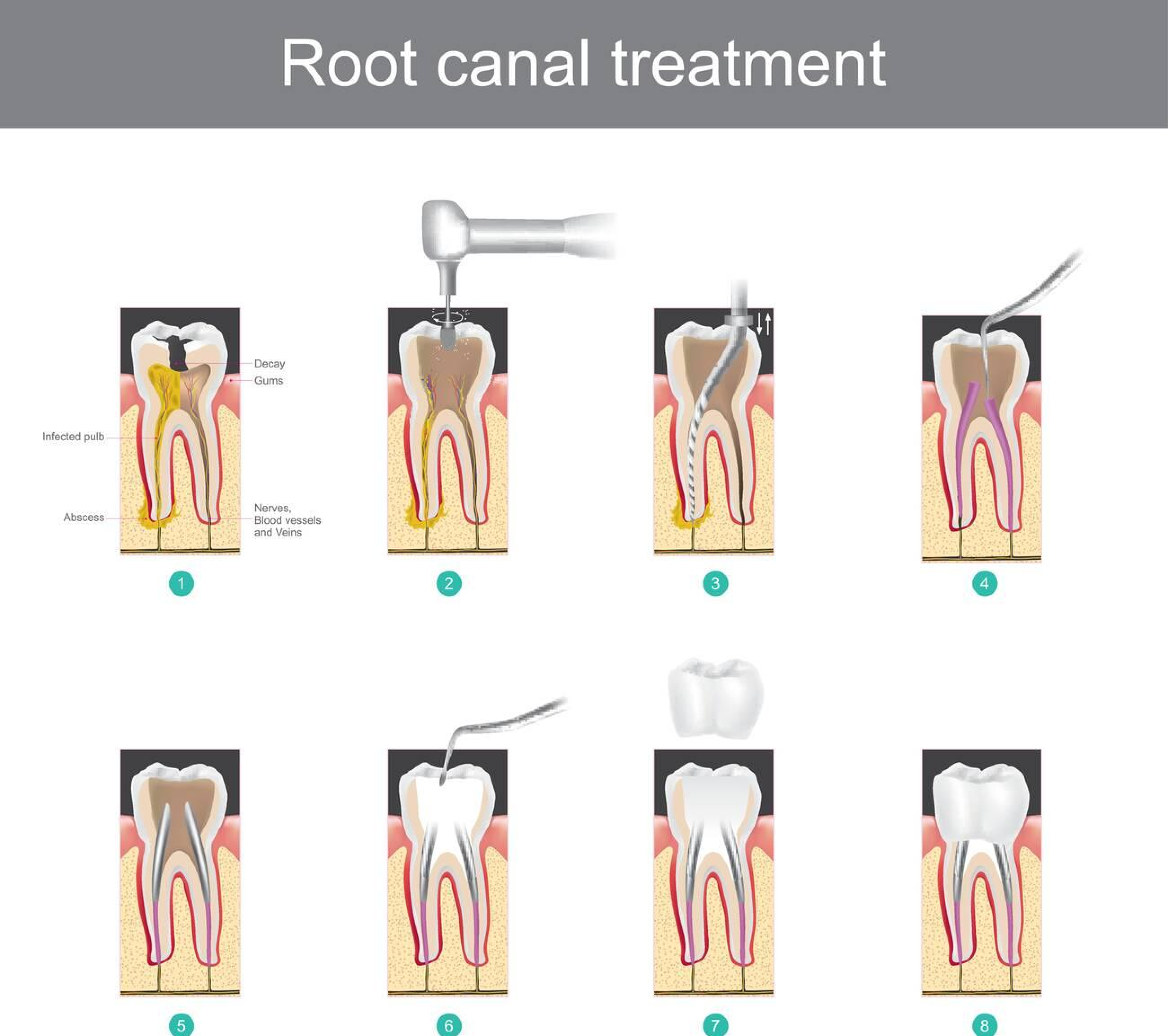 How Long Does Endodontic Therapy Last?