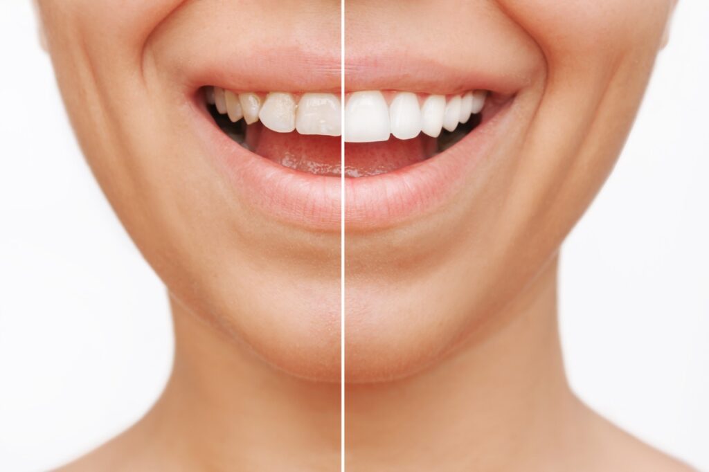Teeth Whitening vs. Veneers: Which One Is Right for You? Teeth Whitening vs. Veneers: Which One Is Right for You?