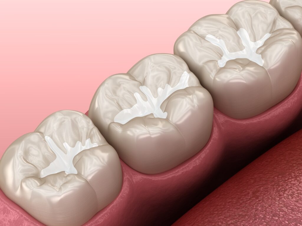 What Is a Dental Sealant and How Does It Prevent Cavities? What Is a Dental Sealant and How Does It Prevent Cavities?
