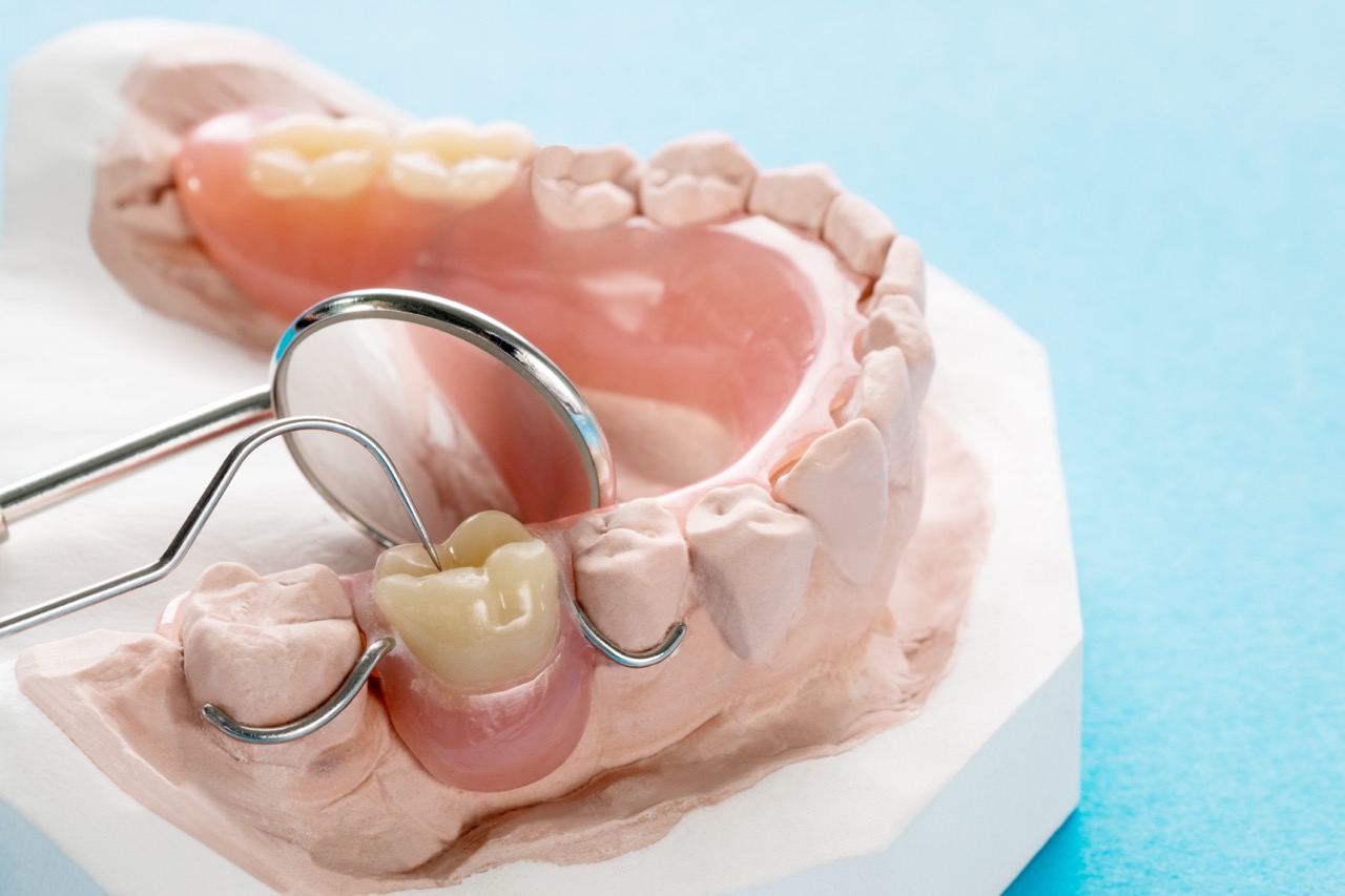 Jasper Partial Dentures | Jasper Dentist | Kiefer Family Dental