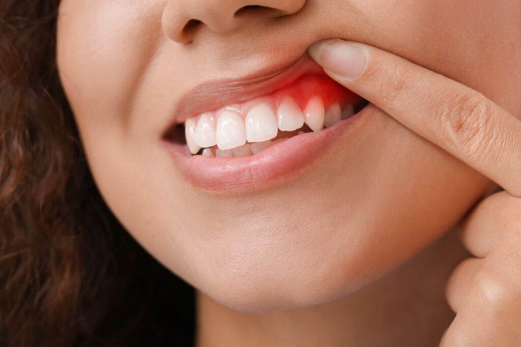 What Are the Warning Signs of Gum Disease?
