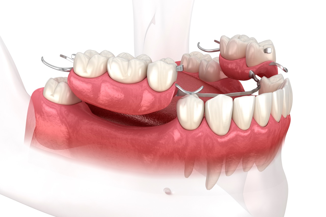 Affordable Boonville Partial Dentures Near Indiana | Kiefer Dental