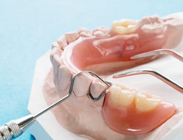 Artificial removable partial denture.