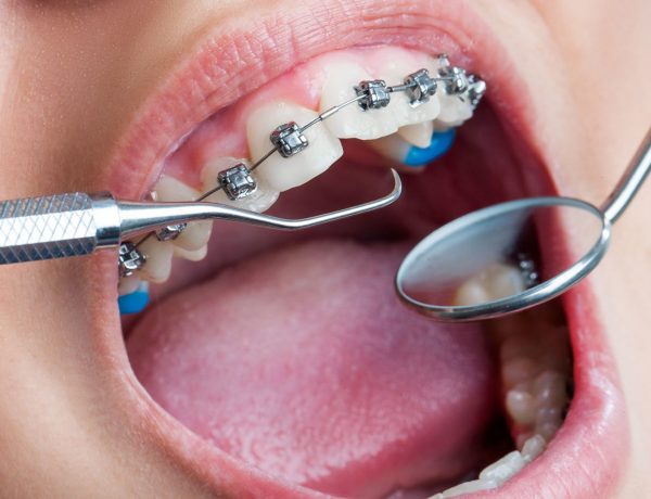 Orthodontic-Treatment-and-Dental-Caries-1920x1080